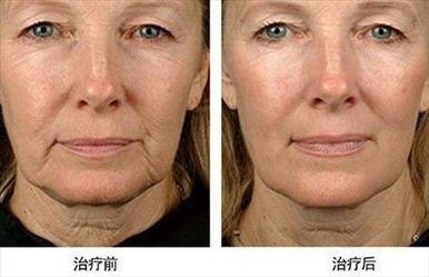 做完塑美極注意事項(xiàng)