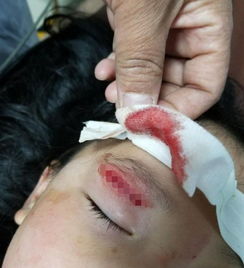 5歲半孩子手骨折注意事項