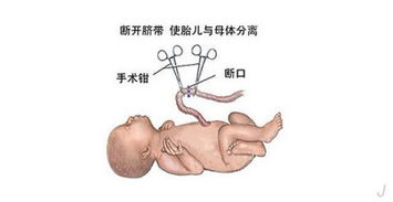 舌臍帶手術(shù)注意事項(xiàng)