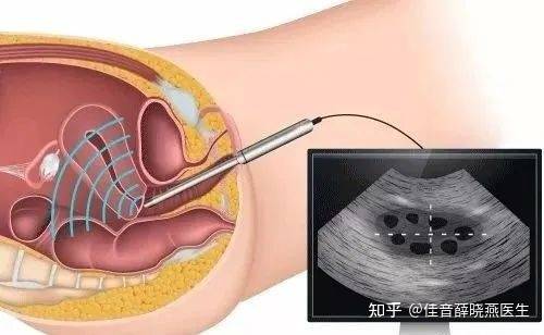 移植動(dòng)胚前注意事項(xiàng)