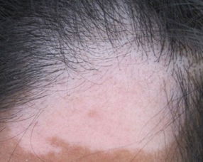 男性白癜風注意事項