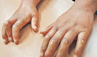 注意事項(xiàng),小孩,硬皮病