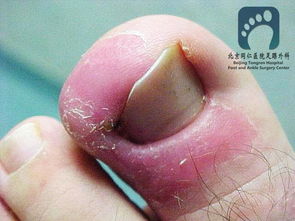 嵌甲手術(shù)后注意事項(xiàng),嵌甲剪指甲時(shí)注意事項(xiàng),嵌甲取出后注意事項(xiàng)