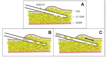 脂肪抽吸術(shù)后注意事項