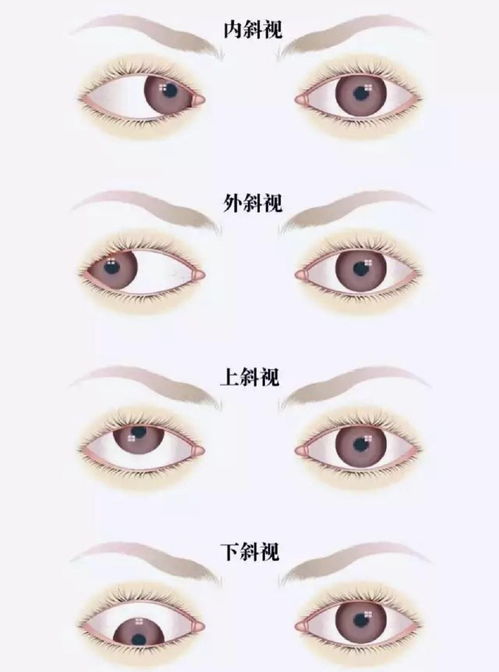 斜視,術(shù)后,注意事項(xiàng),兒童