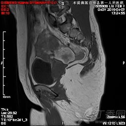 mri增強(qiáng)檢查注意事項(xiàng)和禁忌癥,mri增強(qiáng)檢查后注意事項(xiàng),增強(qiáng)mri檢查需要注意事項(xiàng)