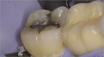 貴金屬補(bǔ)牙后注意事項(xiàng)