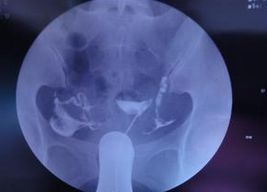 做造影之前注意事項,做頭部和頸部造影前注意事項,做了頭部造影后注意事項