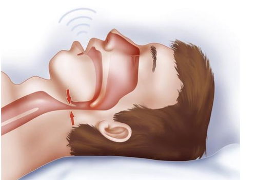 口咽通氣法的注意事項(xiàng)