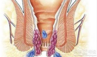 痔瘡手術(shù)后應注意什么,痔瘡手術(shù)后應注意哪些事項,痔瘡手術(shù)后應注意事項?