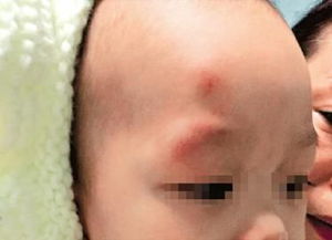 寶寶縫針后注意事項,摔傷縫針后注意事項,下巴摔傷縫針注意事項