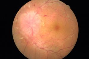 視神經(jīng)乳頭炎注意事項