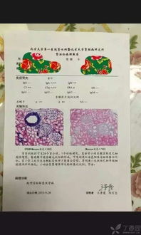 淀粉樣變腎病飲食注意事項(xiàng)