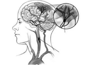 腦梗注意事項大全