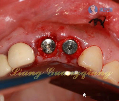 要注意,事項(xiàng),牙植骨