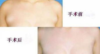 切副乳后注意事項(xiàng)