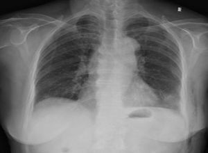 胸腺癌放化療注意事項