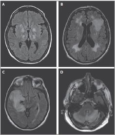 腦炎飲食注意事項(xiàng),自身免疫性腦炎注意事項(xiàng),兒童腦炎注意事項(xiàng)