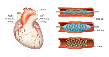 心臟補洞后注意事項