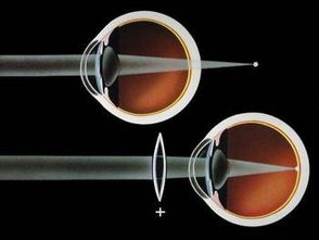 遠視眼,注意事項