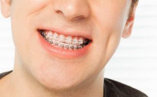 戴牙套的注意事項(xiàng),戴牙套需要注意什么,剛戴牙套注意事項(xiàng)