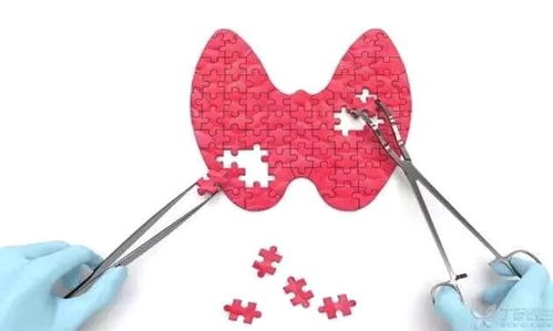 甲狀腺切除術(shù)后注意事項(xiàng),切掉甲狀腺后注意什么,甲狀腺切除需要注意什么