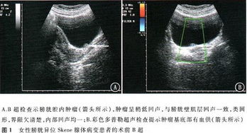 女性查體b超注意事項
