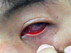 結(jié)膜炎注意事項(xiàng)和如何恢復(fù),結(jié)膜炎一般多久能好結(jié)膜炎注意事項(xiàng),結(jié)膜炎日常注意事項(xiàng)