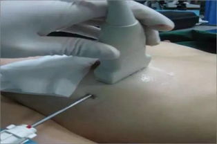 乳房腫瘤微創(chuàng)手術(shù)后注意事項