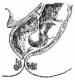 直腸息肉術(shù)后注意事項(xiàng),直腸腫瘤灌腸的注意事項(xiàng),直腸藥物灌腸注意事項(xiàng)