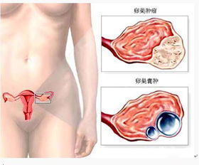 手術(shù)后,注意事項(xiàng),卵巢癌