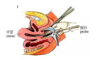 注意事項,節(jié)育環(huán)
