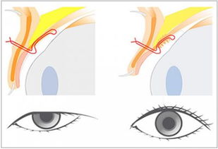 上瞼下垂手術(shù)拆線后注意事項(xiàng),上瞼下垂矯正術(shù)后注意事項(xiàng),上瞼下垂術(shù)后飲食注意事項(xiàng)