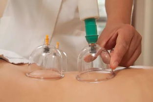 注意事項(xiàng),醫(yī)生,拔罐