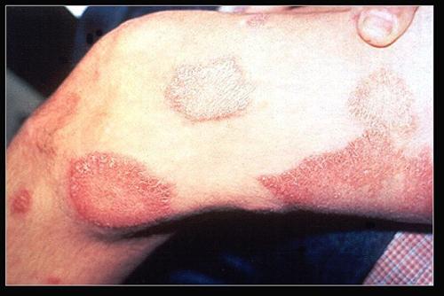 麻風(fēng)疫苗紅疹注意事項