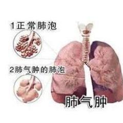肺氣腫,應(yīng)注意,事項