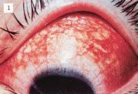 結(jié)膜炎注意事項(xiàng)好大夫在線