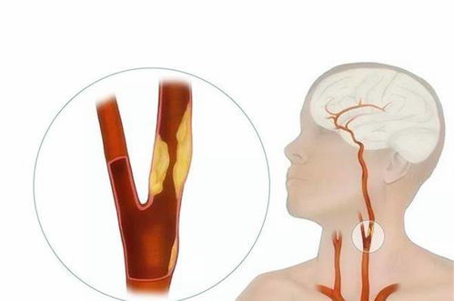 頸動(dòng)脈b超檢查注意事項(xiàng),頸動(dòng)脈彩超檢查注意事項(xiàng),頸動(dòng)脈cta檢查注意事項(xiàng)