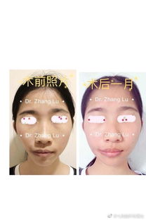 整形,面部,不對(duì)稱,注意事項(xiàng)