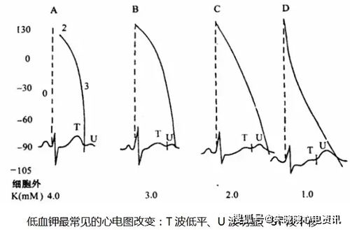 低鉀血癥飲食注意事項(xiàng),低鉀血癥出院注意事項(xiàng),低鉀血癥治療原則及注意事項(xiàng)
