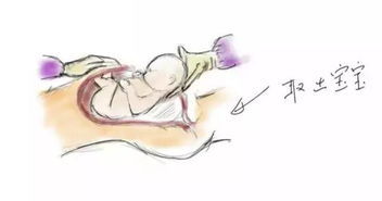 刨腹產(chǎn)流程及注意事項