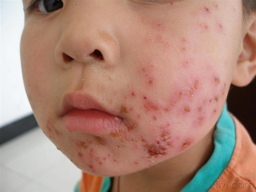 膿包瘡的注意事項(xiàng)