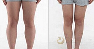 大腿抽脂術(shù)后注意事項(xiàng),大腿抽脂后的注意事項(xiàng),大腿抽脂前注意事項(xiàng)