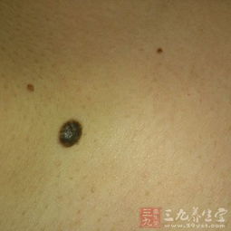 去完黑痣注意事項(xiàng)