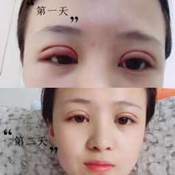 縫完雙眼皮注意事項