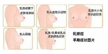 乳頭乳暈漂色注意事項(xiàng)