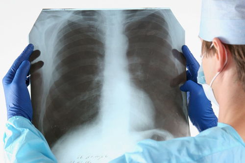 氣胸的治療及注意事項(xiàng)