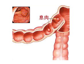 直腸,息肉,注意事項,飲食
