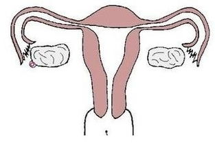 造影,輸卵管,注意事項,檢查
