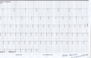阿托品激發(fā)試驗(yàn)注意事項(xiàng),做完阿托品試驗(yàn)注意事項(xiàng),阿托品的使用方法和注意事項(xiàng)